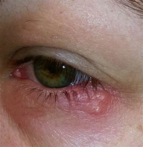 List 90+ Pictures Herpes Of The Eyes Pictures Completed 10/2023