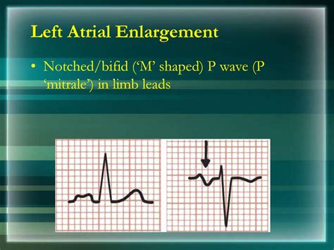 Basics of ECG - презентация онлайн