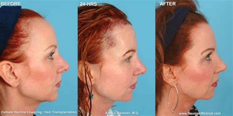 Female Hairline Lowering · Bauman Medical