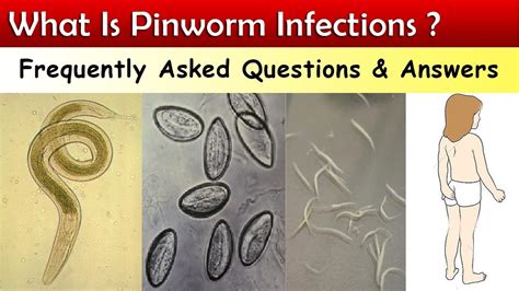 What Is Pinworm Infections ? ( FAQ & Answers ) - YouTube