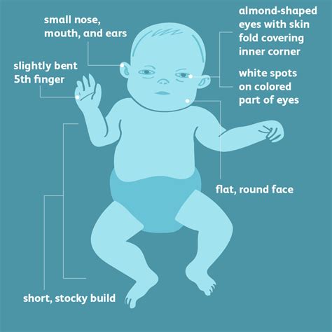 What is Down Syndrome? – AnthosHouse