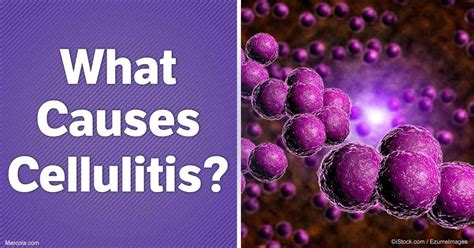 What Causes Cellulitis Infection?