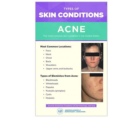 Acne: Signs and symptoms