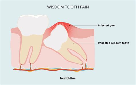 Wisdom Tooth Pain: Relief, Treatment, and More