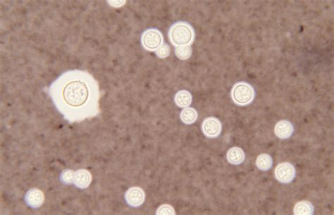 Cryptococcus neoformans - DocCheck