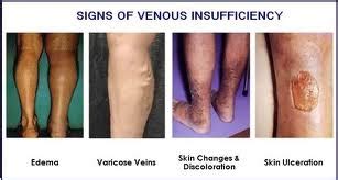 Chronic Venous Insufficiency Singapore|Symptoms to Treatments