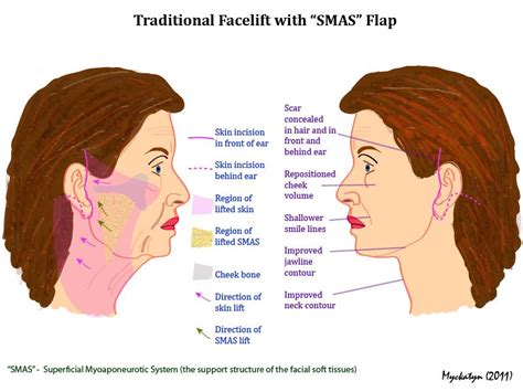 Facelift | St. Louis | West County Plastic Surgeons