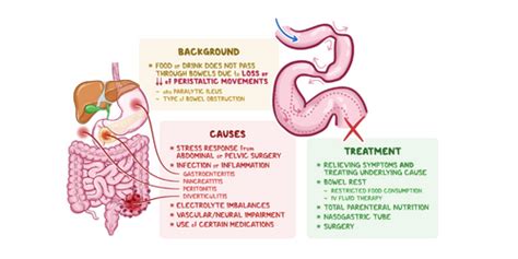 Adynamic Ileus Causes & Treatments, Know It All Here! - Medical Treatment