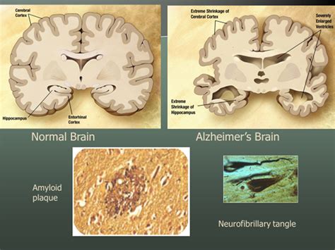 What is Alzheimer's Disease?