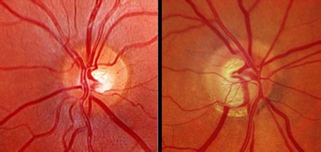 Undoing the Damage of Glaucoma | Science | AAAS