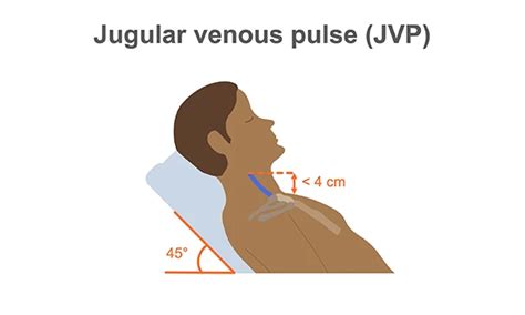 Measuring the jugular venous pulse | Medmastery