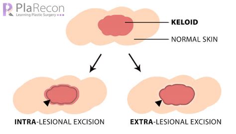 Keloid Management: Prevention and Treatment