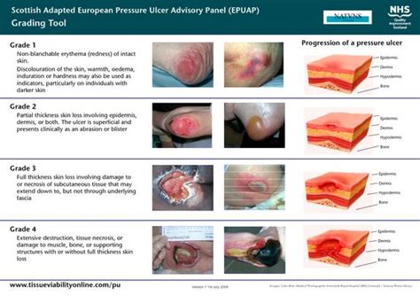 ulcer classification | Scottish Adapted European Pressure Ulcer ...