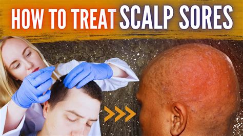 Pictures Of Sores And Scabs On Scalp: Causes And More, 44% OFF