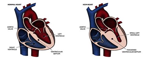 Stiff Heart Syndrome Symptoms - Quotes Marco