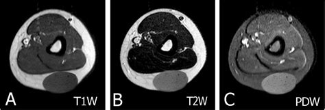 Overview of epidermoid cyst - European Journal of Radiology Open