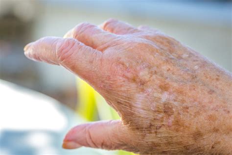 5 remedios caseros para eliminar manchas por la edad | Salud180