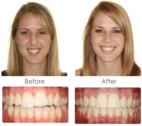 Cosmetic Braces - G1 Dental Practice | NHS Dentist Glasgow City Centre