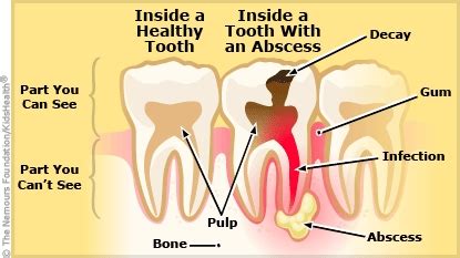 A to Z: Abscess, Periapical (for Parents) - Nemours