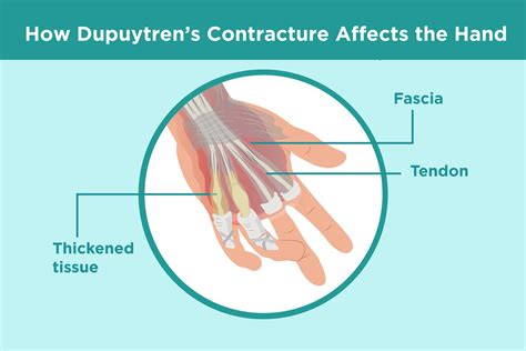 Dupuytren’s Contracture: Treatment, Surgery, Getting Relief