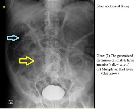 Paralytic Ileus