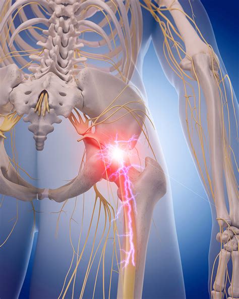 Treatment for Sciatica | Sutton Osteopath | Claire Craven