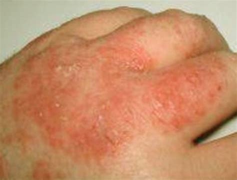 Fungal Rash Pictures