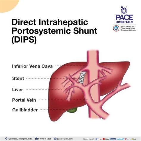 How Risky Is Liver Shunt Surgery: A Comprehensive Analysis