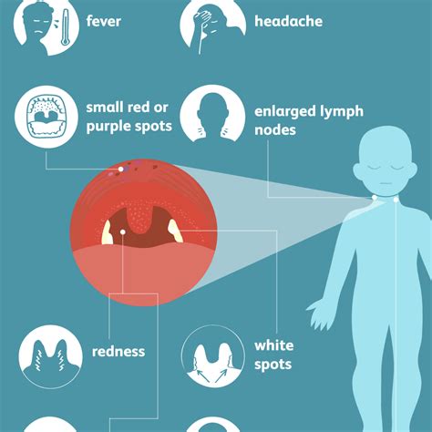 What Helps Strep Throat | Examples and Forms