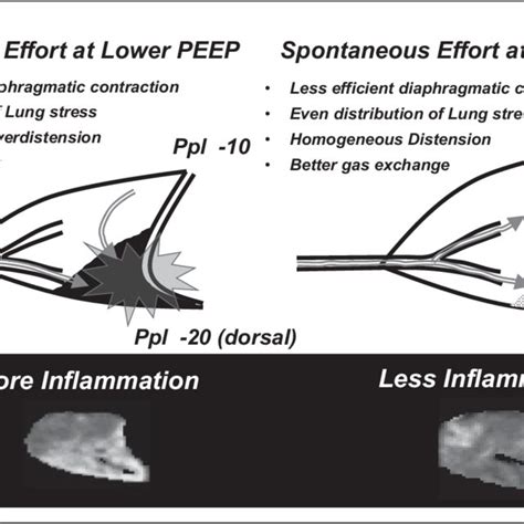 Lower PEEP in severe ARDS presents more lung collapse, resulting in ...