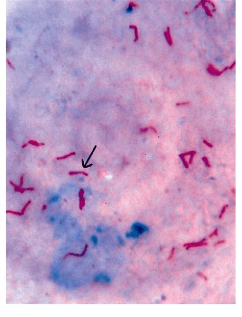 Microphotograph of TB bacillus, Mycobacterium tuberculosis on an ...