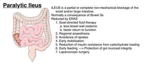 Paralytic Ileus