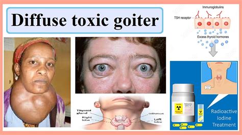 Nontoxic Multinodular Goiter Causes Symptoms Treatment