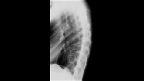 Thoracic Spine Radiology Tutorial - YouTube