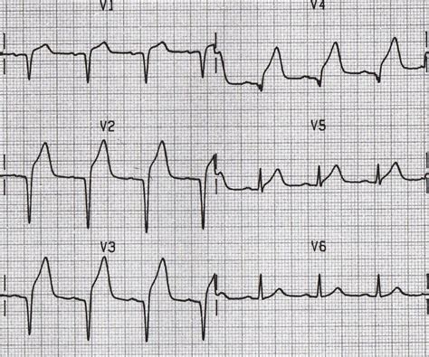 anterior STEMI q waves. Q waves are considered pathological if: > 40 ms ...