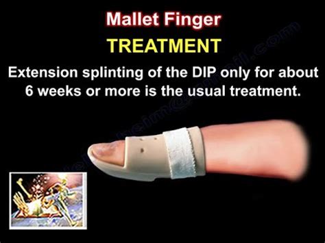 Mallet Finger Treatment - Everything You Need To Know - Dr. Nabil ...