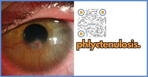 Understanding Phlyctenulosis: Causes, Symptoms, Treatment, and Prevention