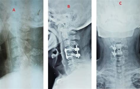 Plain film X-Ray from left to right: A-Pre-operative lateral showing a ...