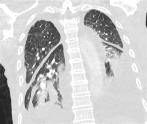 000 Fissures of the Lung | Lungs