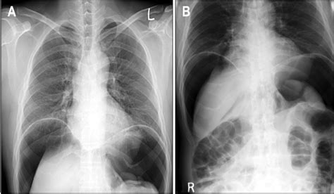 Plain film of the chest X-ray (A) and simple abdomen (B). After colon ...