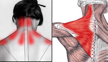 Trapezitis | Trapezius | Ayurvedic Treatment | Nagarjuna Ayurveda