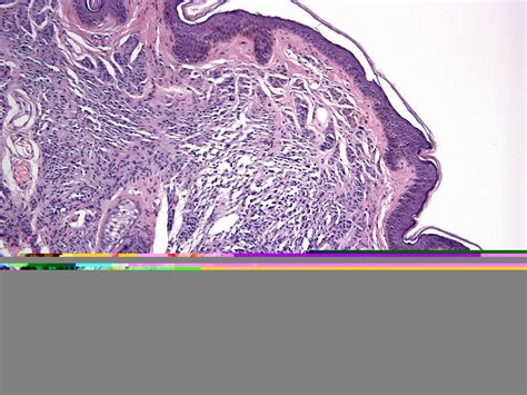 Congenital melanocytic nevus - Dermatology Advisor