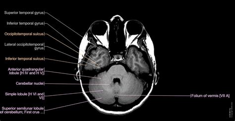 Axial Head Mri Scan