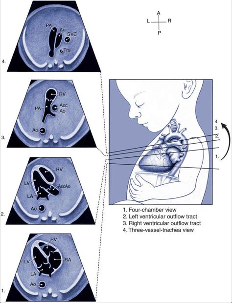 Fetal Lvot Ultrasound