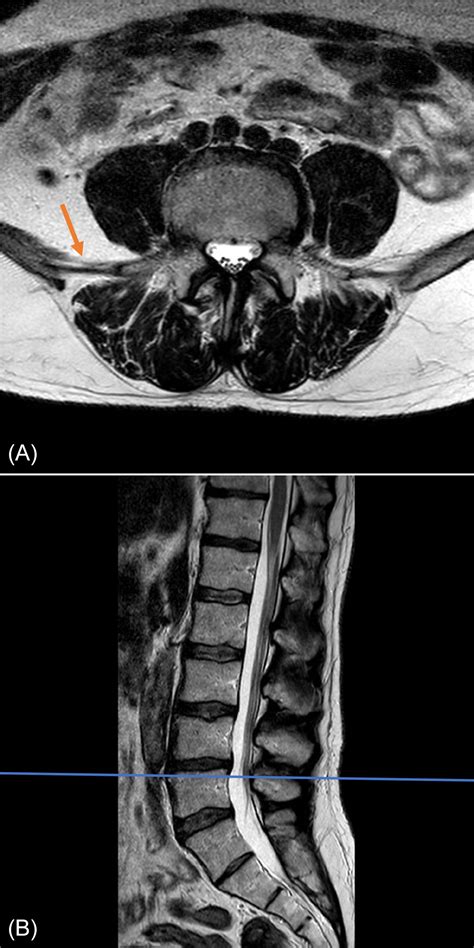 Lumbar Spine Mri Axial