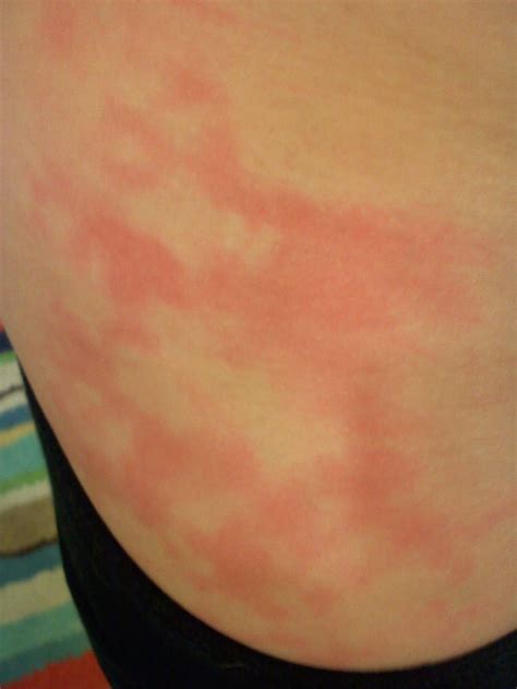 red blotchy rash - pictures, photos