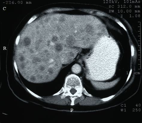 Liver metastases. Causes, symptoms, treatment Liver metastases