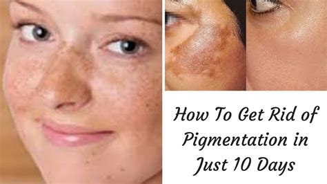 Face Pigmentation Treatment At Home - Doctor Heck