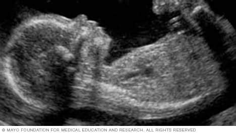 Slide show: Fetal ultrasound - Mayo Clinic