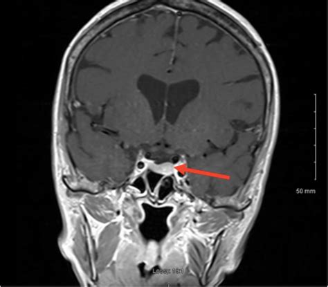 Pituitary Mri